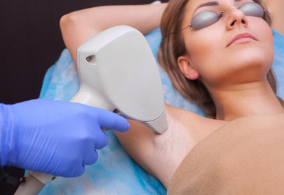 Keuntungan dan Efek Samping Perawatan Laser Hair Removal